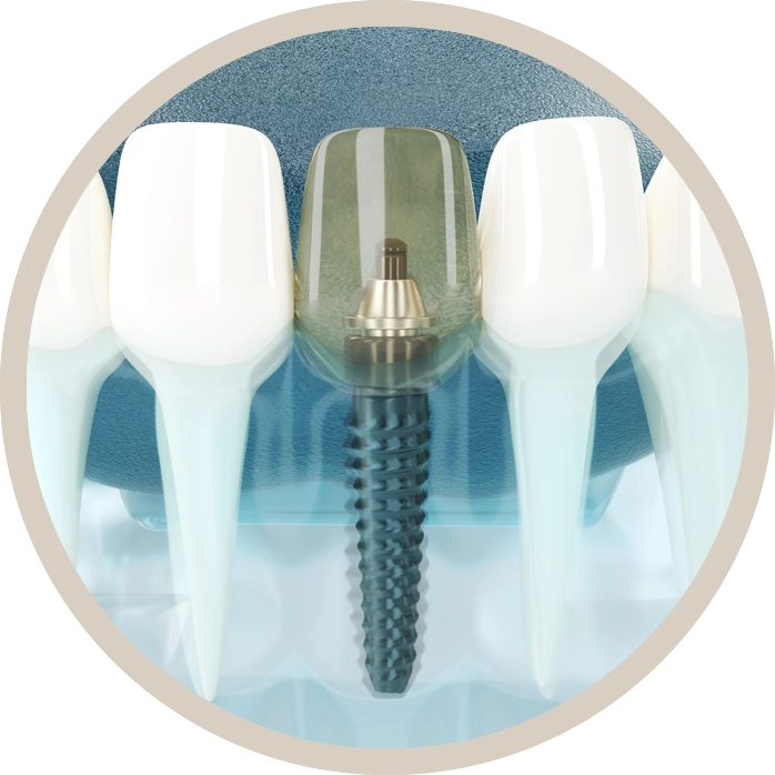Implantes Dentales de alta calidad en Clínica Dental Ripoll