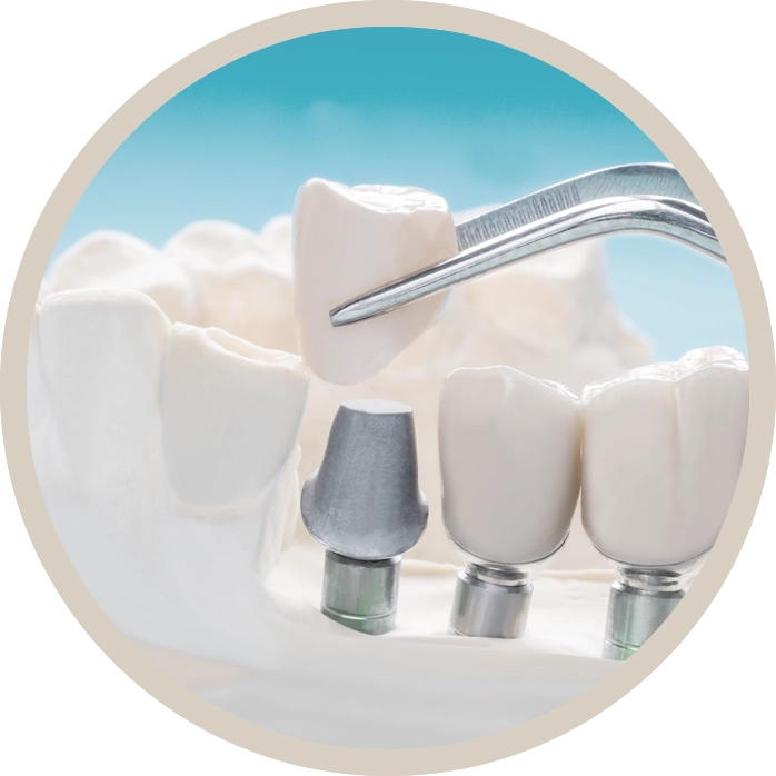 Prótesis Dental Personalizada en Ripoll - Funcionalidad y Estética.